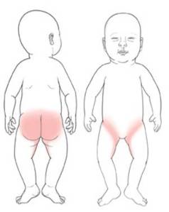 Diaper rash area